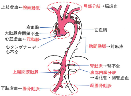 大動脈解離を疑ったら 医療関係者の方へ 済生会西条病院